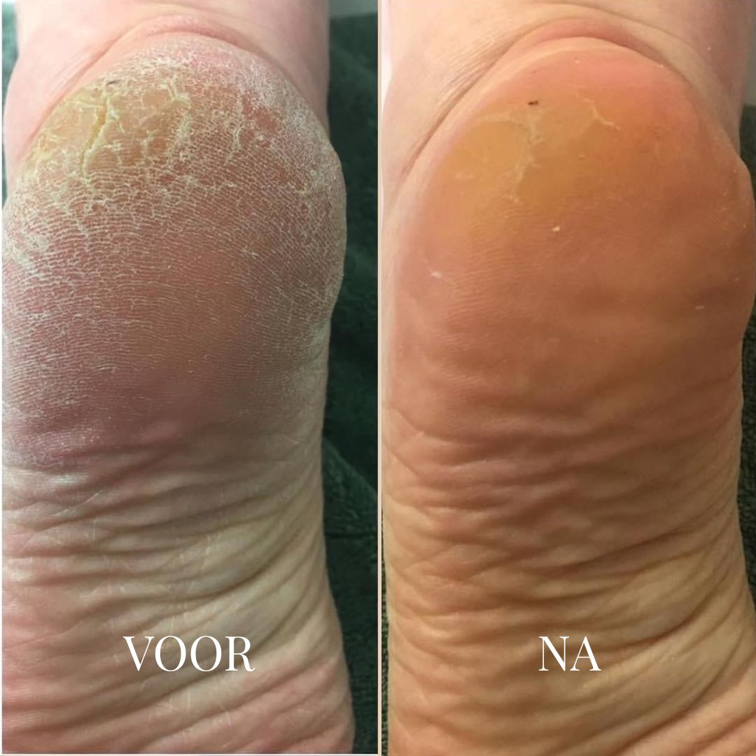 SOFTSTEP EELT VERWIJDERAAR