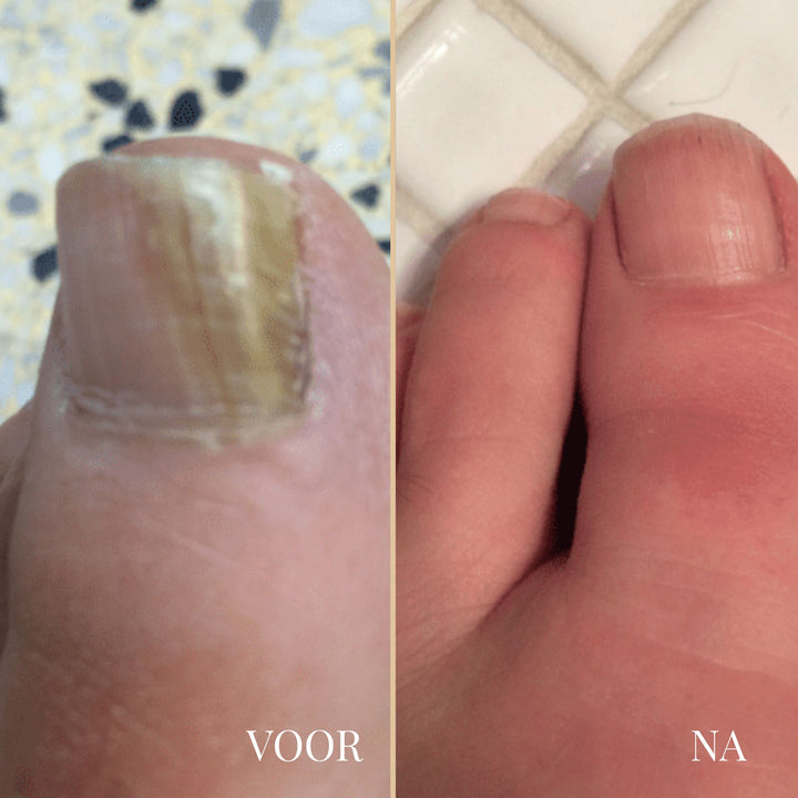 NailEase Nagelpilz-Pflegestift