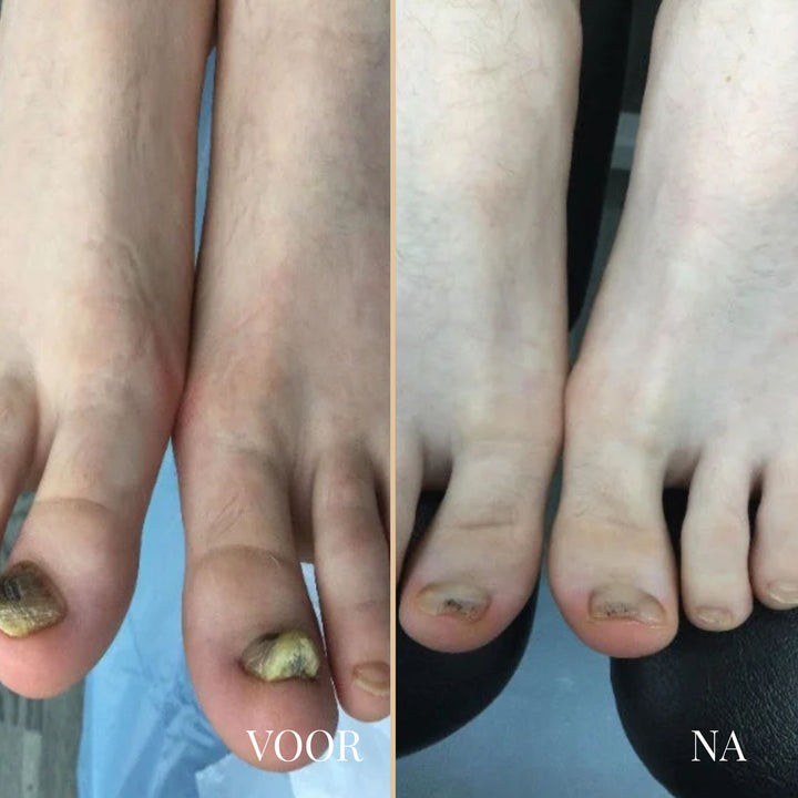 NailEase Nagelpilz-Pflegestift