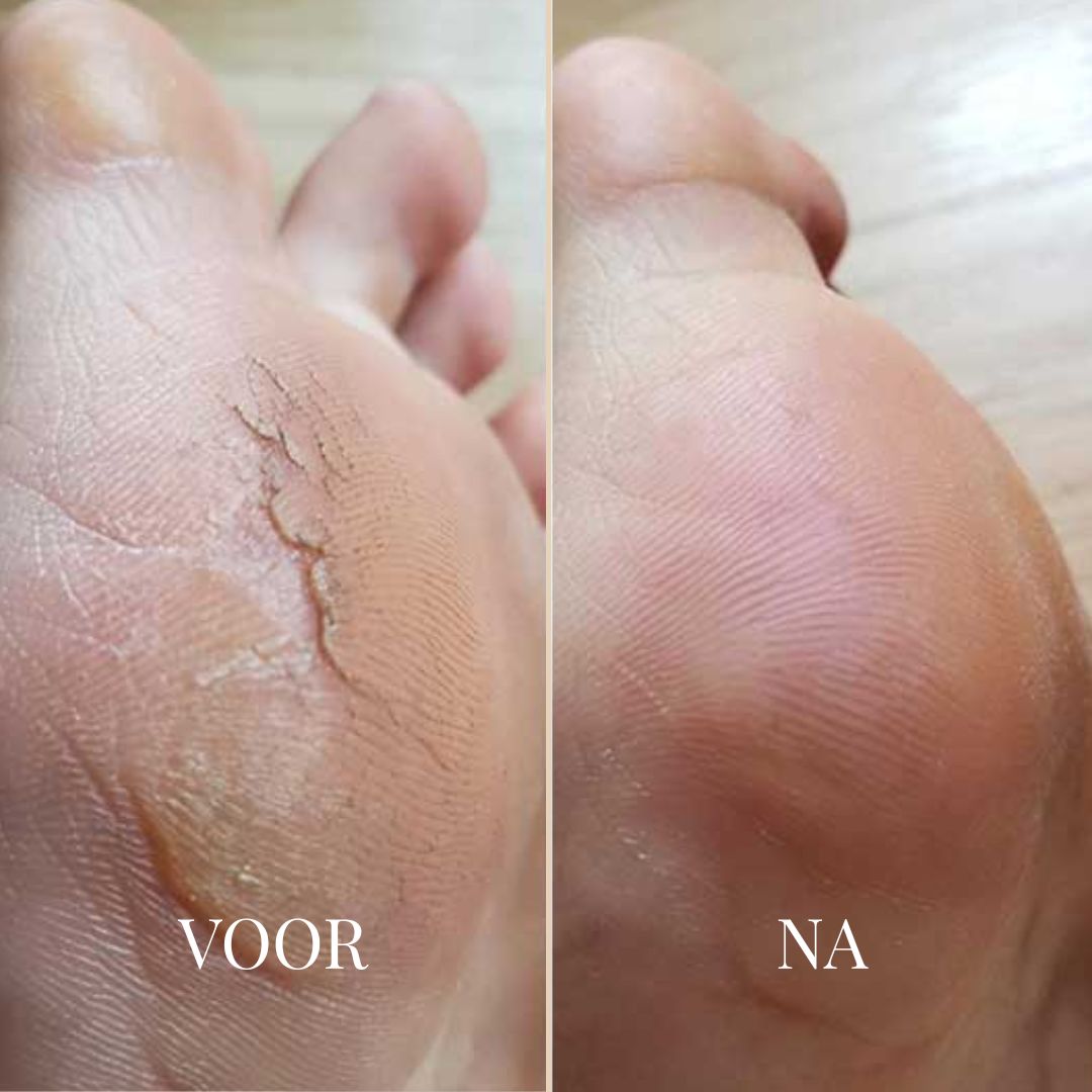 SOFTSTEP EELT VERWIJDERAAR