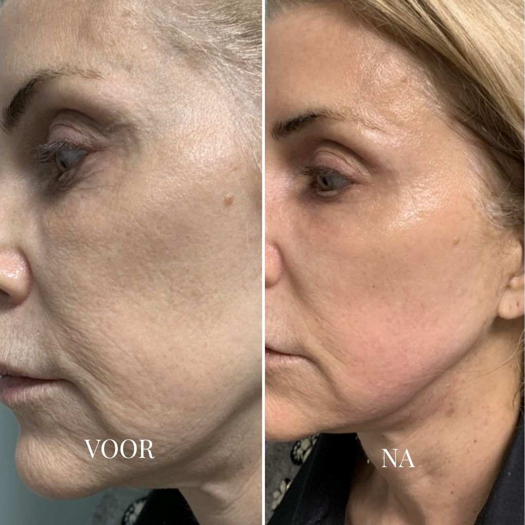 YOUTHLIFT ANTI-VEROUDERINGS KIT