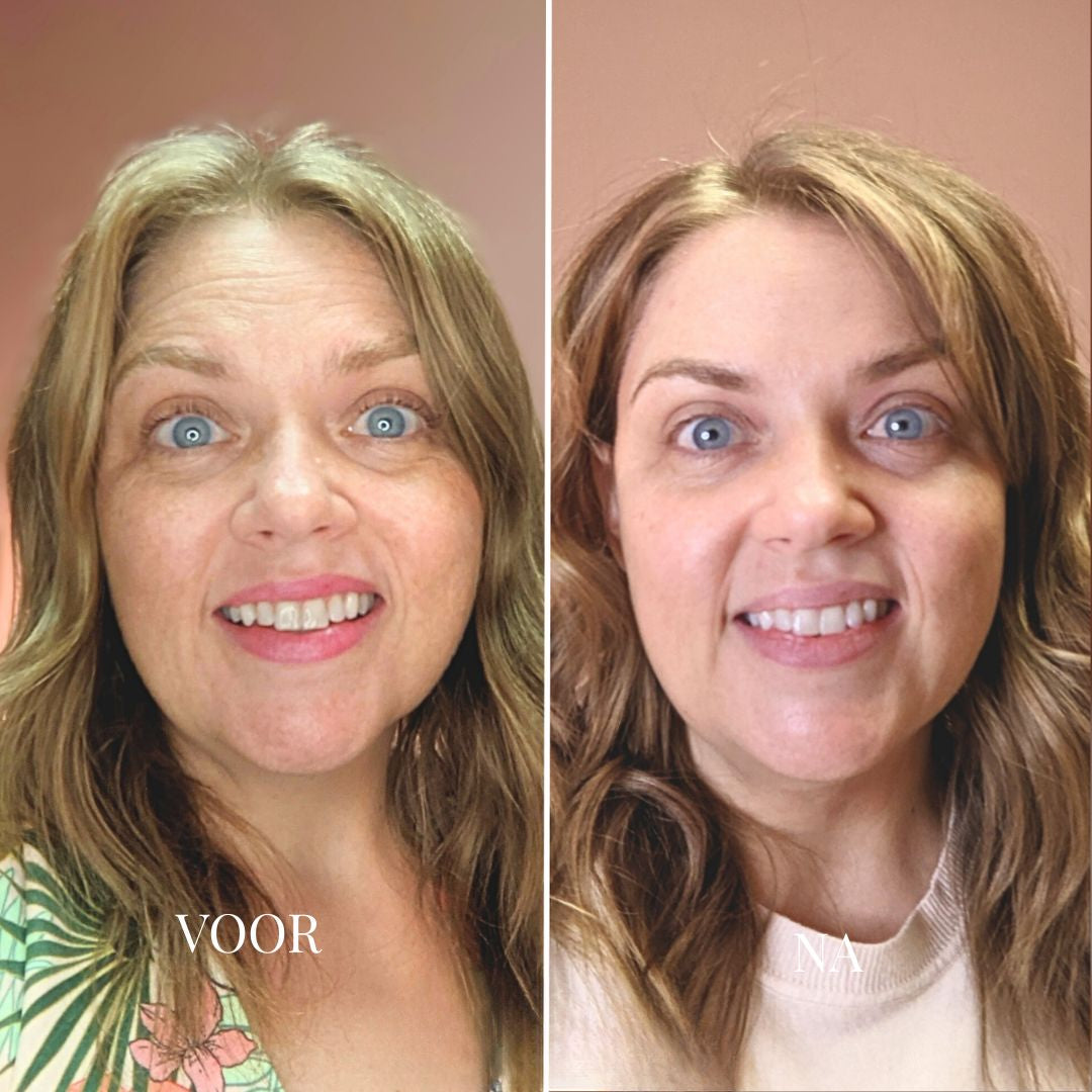 YOUTHLIFT ANTI-VEROUDERINGS KIT