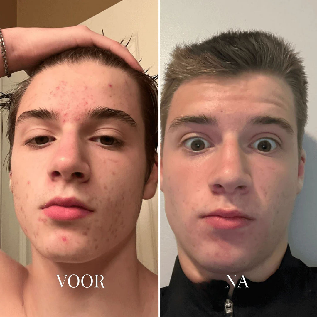 Porify Mitesser-Entferner