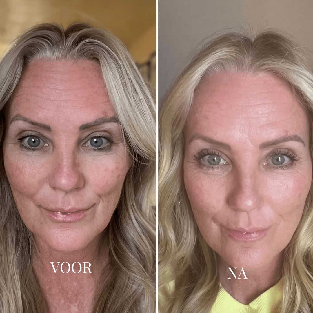 YOUTHLIFT ANTI-VEROUDERINGS KIT