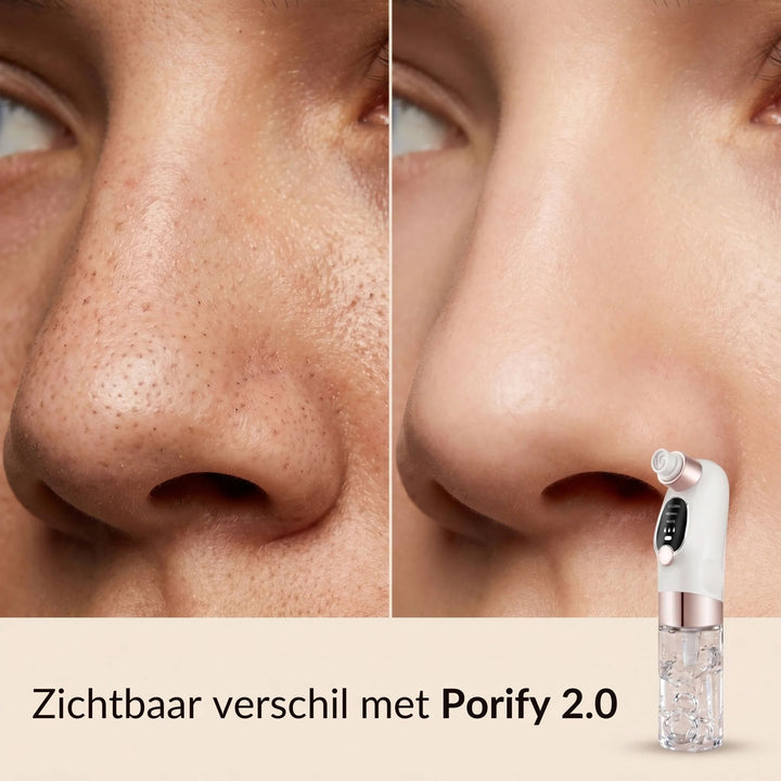 Porify Mitesser-Entferner