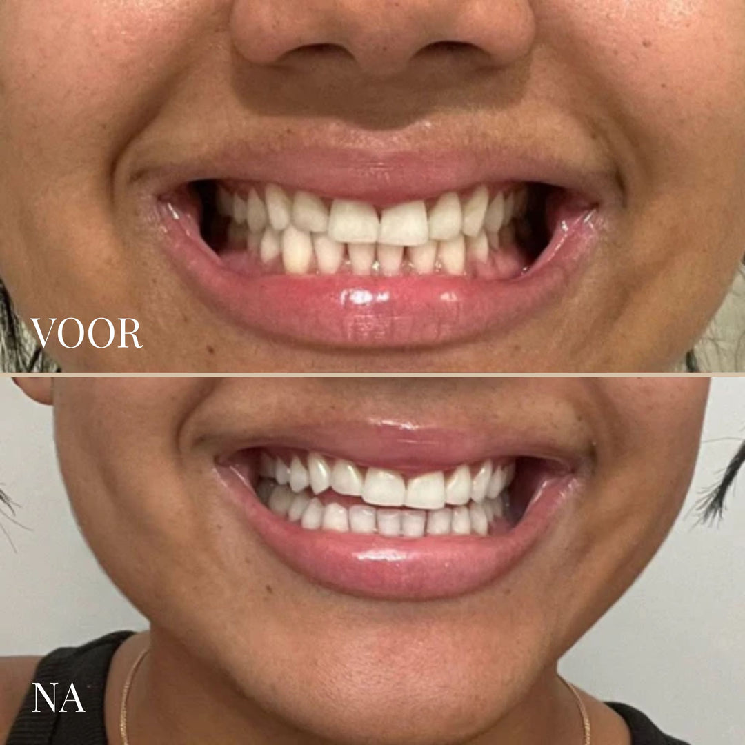 SMILESCULPT ULTRASCHALL-ZAHNBÜRSTE