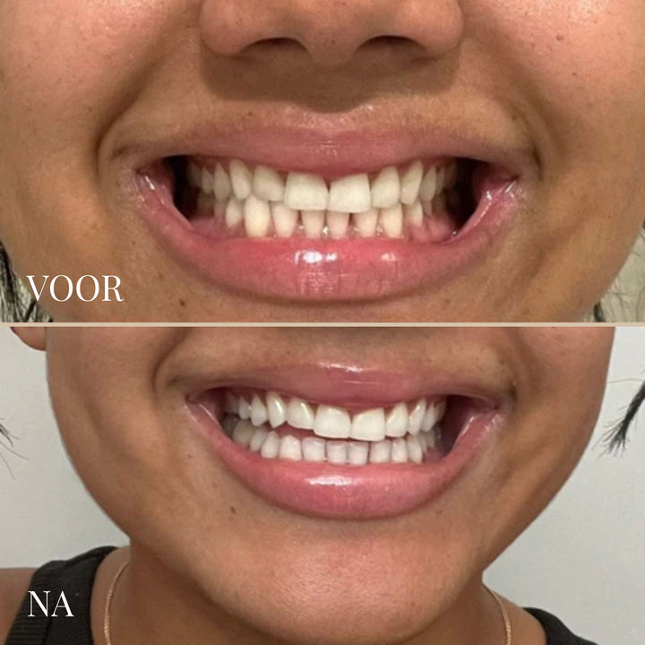 SMILESCULPT ULTRASCHALL-ZAHNBÜRSTE