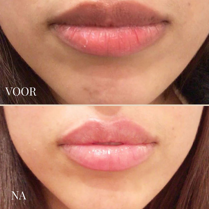 LIPBRIGHT DARK LIPS CREAM | ZICHTBAAR ROZE LIPPEN IN 1-2 WEKEN