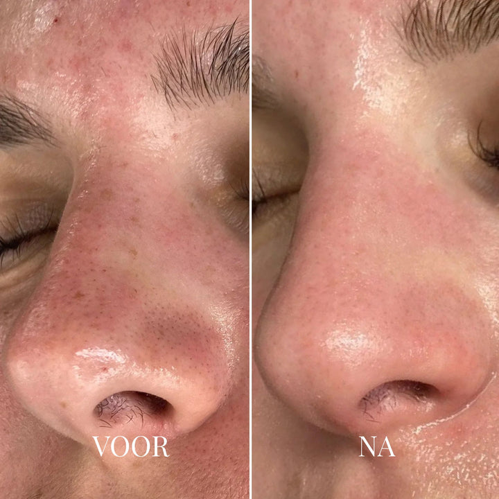 Porify Mitesser-Entferner