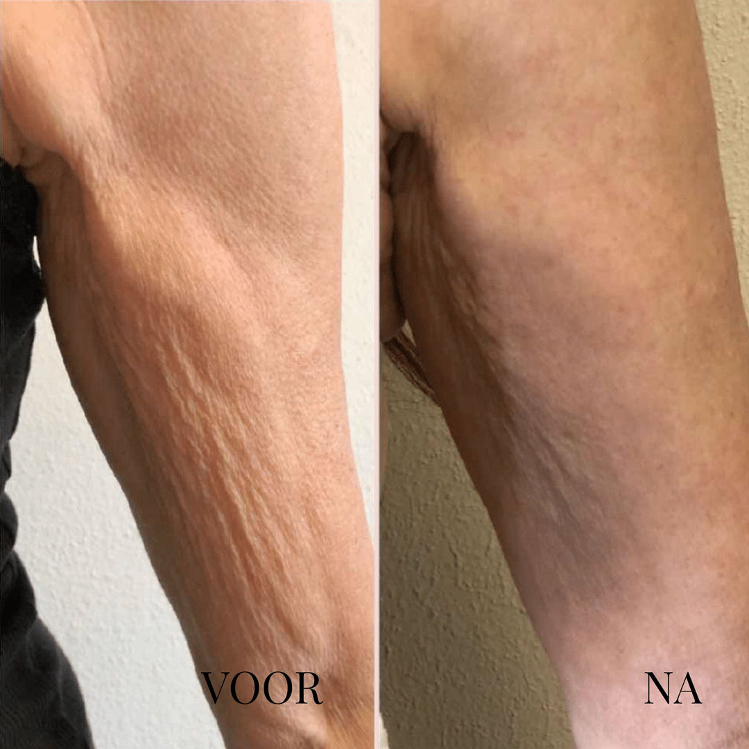 SkinThrive Anti-Cellulitis Roller