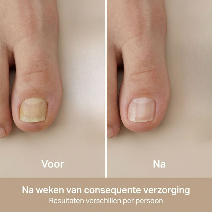 NailEase Nagelpilz-Pflegestift