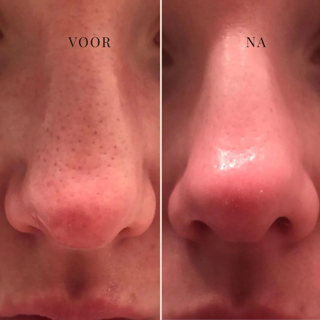 CLEARSILK | NASENMASKE GEGEN TALG