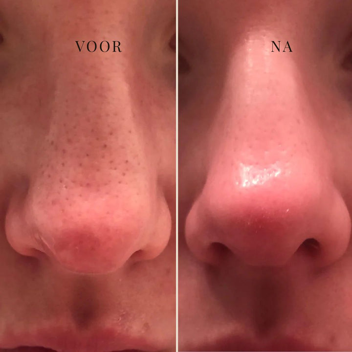 CLEARSILK | NASENMASKE GEGEN TALG