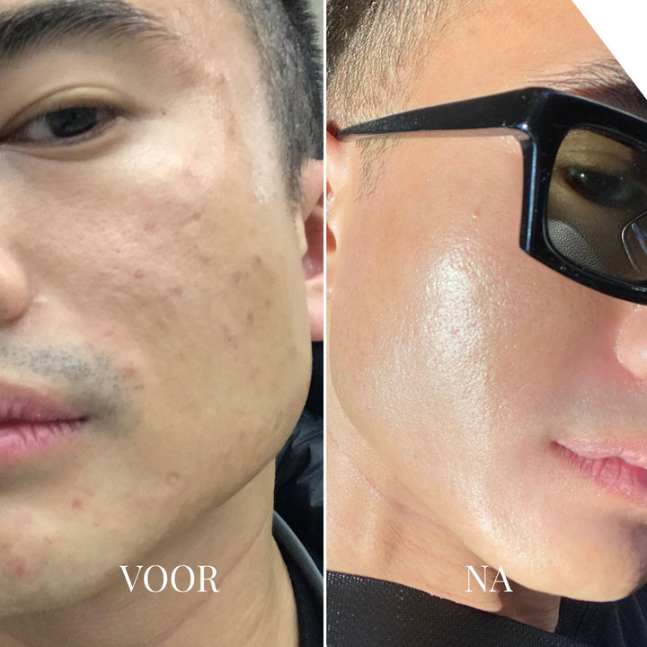 Porify Mitesser-Entferner