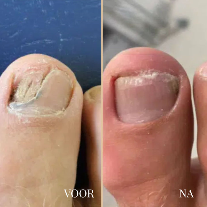 NailEase Nagelpilz-Pflegestift