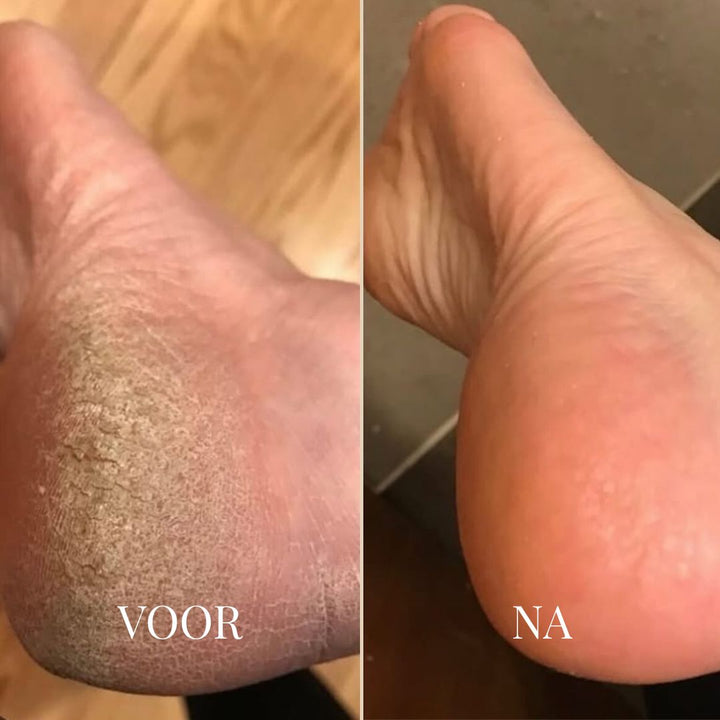 SOFTSTEP EELT VERWIJDERAAR